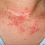Types of Eczema